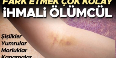 vucudunuzu-kontrol-etmek-hayat-kurtarabilir-bu-belirtiler-kanserin-habercisi-olabilir-JOYV3b14.jpg