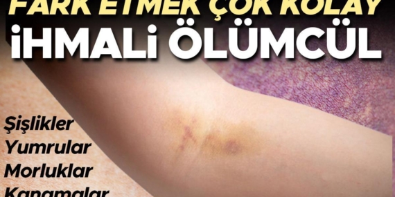 Vücudunuzu Kontrol Etmek Hayat Kurtarabilir: Bu Belirtiler Kanserin Habercisi Olabilir